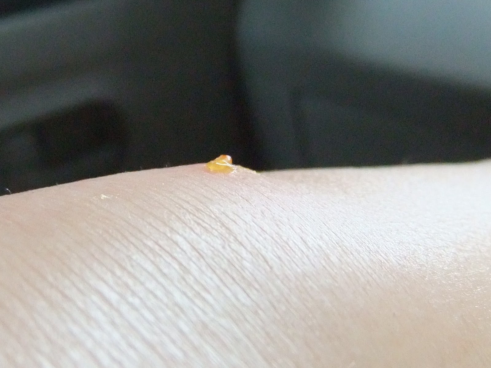 Butik Turkuaz Sand Flies Bite And Treatment