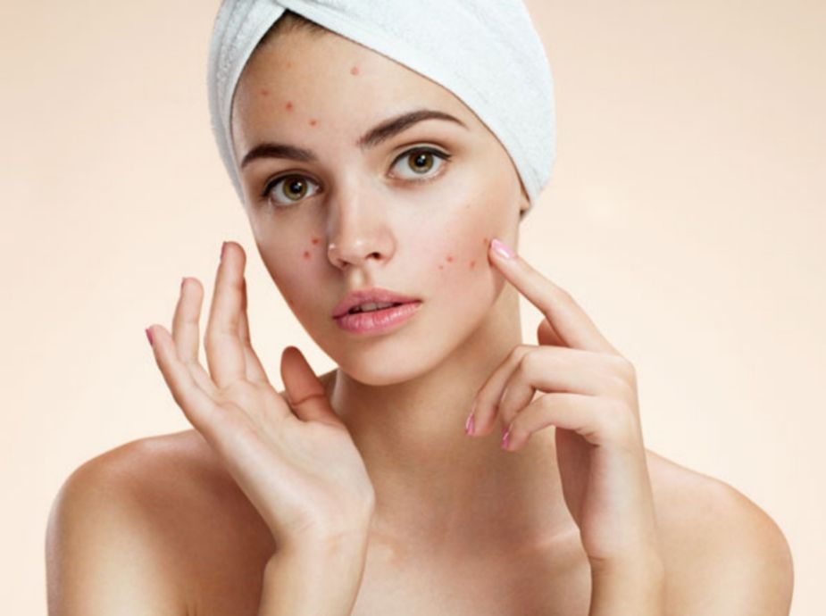 Beauty Tips for Pimples and Blackheads in Marathi