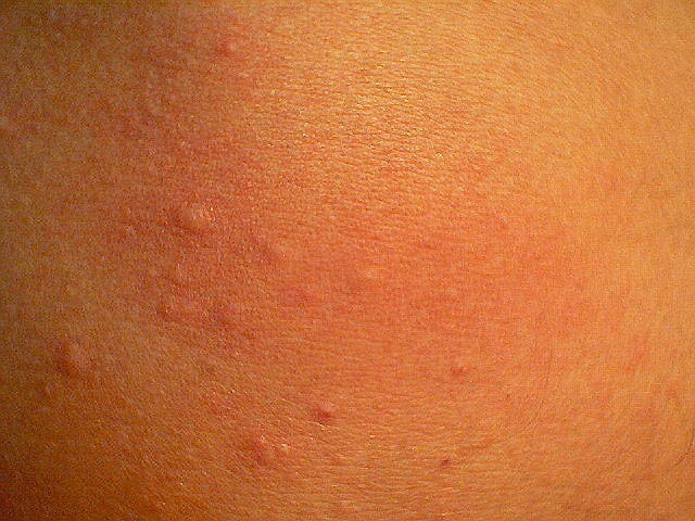 3 Ways to Get Rid of Hives - wikiHow