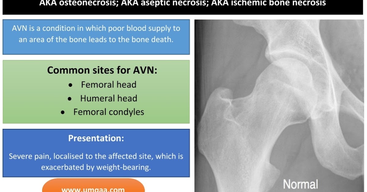 What Are The Causes Of Avascular Necrosis Avn Of The Femoral Head