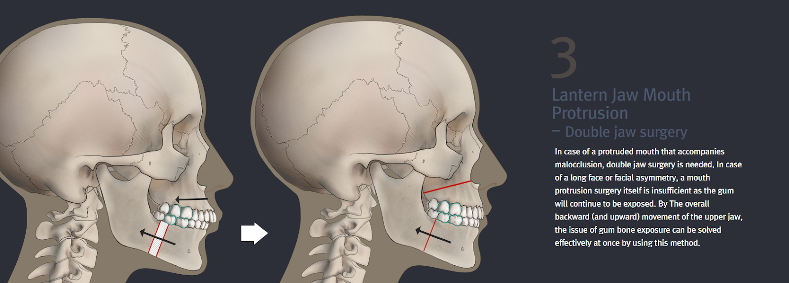 Mouth Protrusion Surgical Method (double jaw surgery, jaw correction)