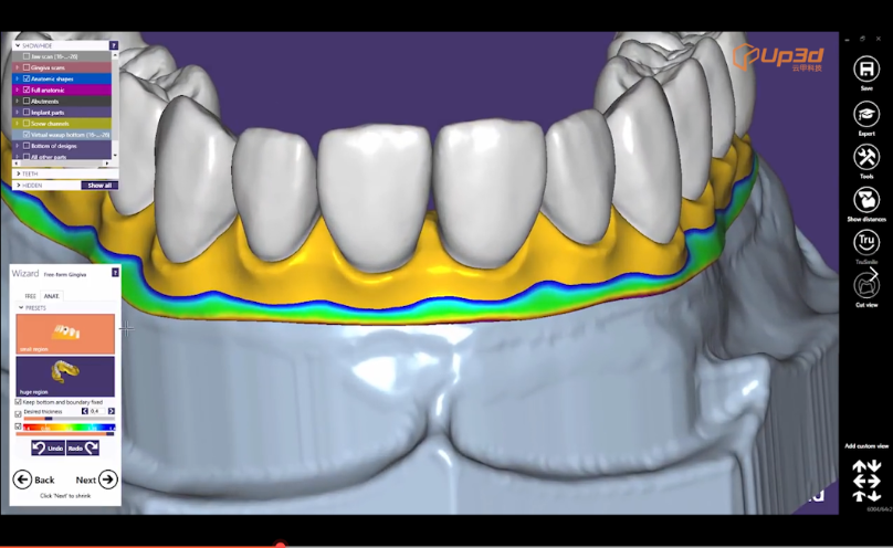Dental CAD/CAM system: Implant Bridge design by exocad