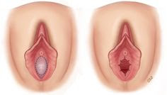 Film of hymen as it is visible from outside after opening lips