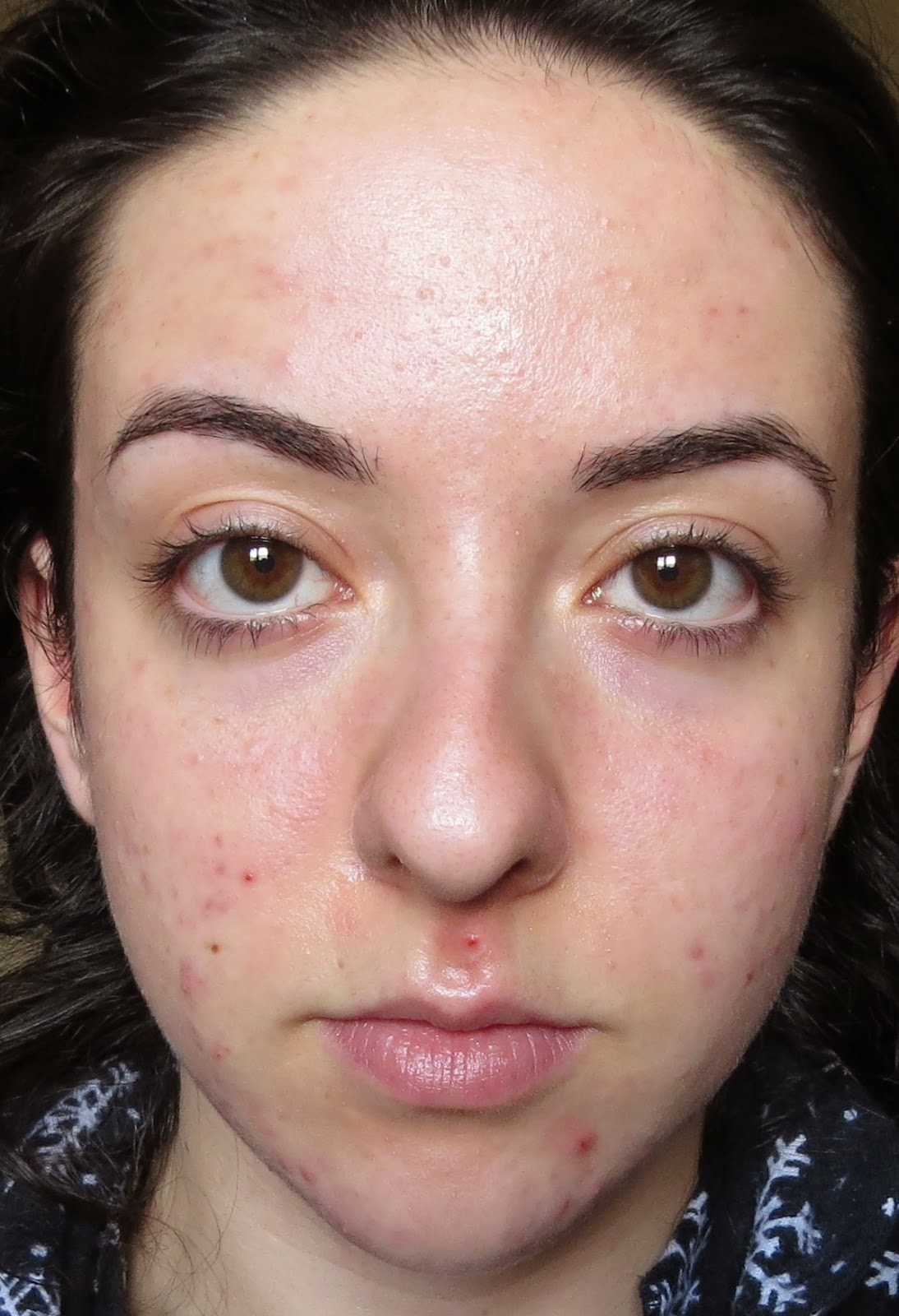 My Skins Journey Week 11 Banish Acne Scars
