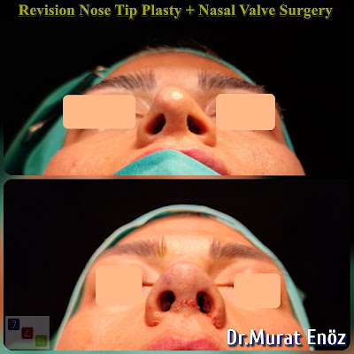 Revision Nose Tip Surgery + Nasal Valve Surgery
