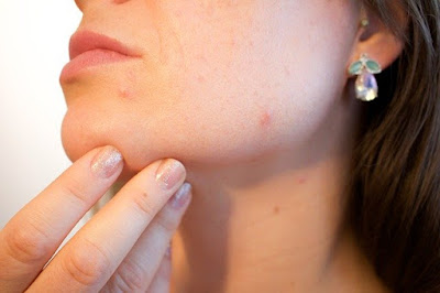 woman touching the acne on her face