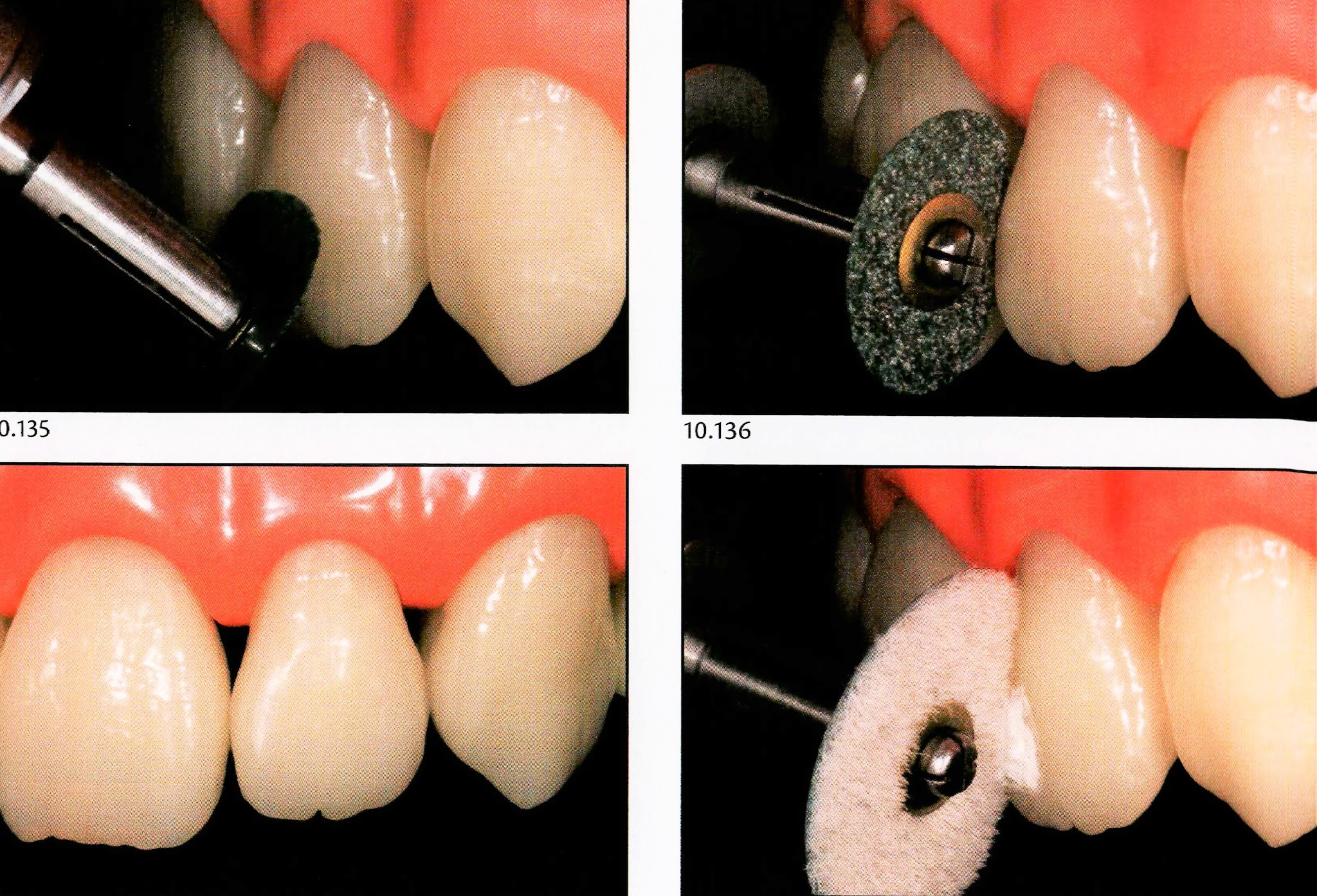 Class III Composite restoration " Labial access " Dental Esthetics