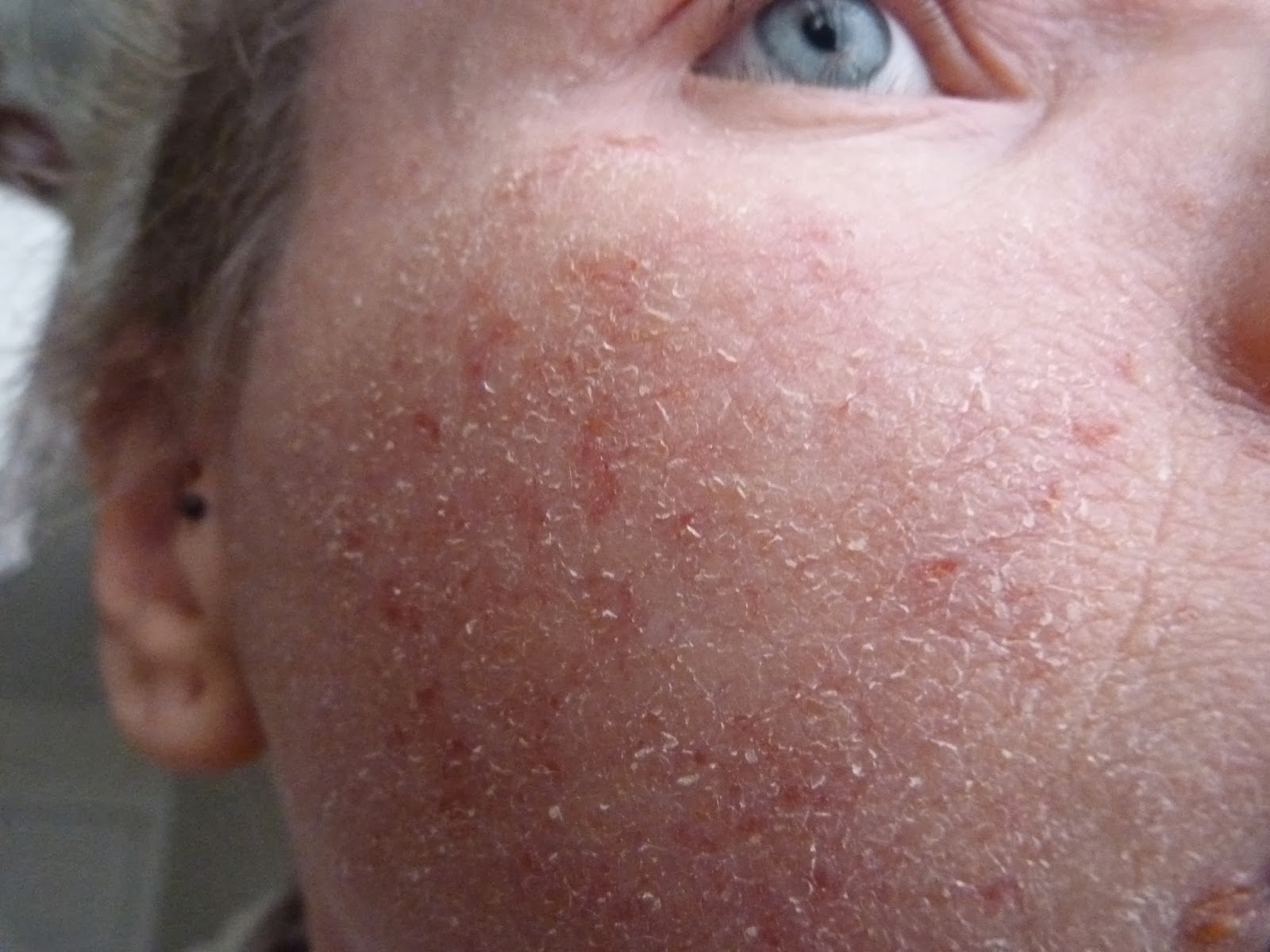 I Have Eczema Happy Birthday I Have Eczema Blog!