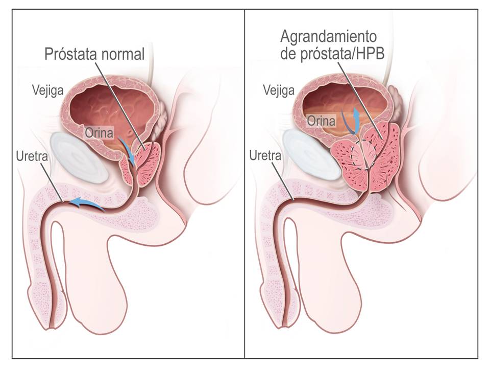 #EAU Testosteronul încetinește recidiva cancerului de prostată la pacienții cu risc scăzut