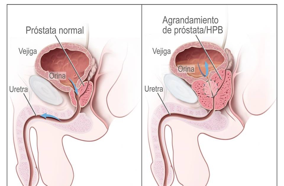 prostatita urina alba psa is what