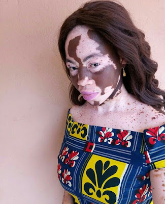 "My mum deserves some accolades for enduring all the societal stigma" - Lady who suffers from Vitiligo celebrates mother
