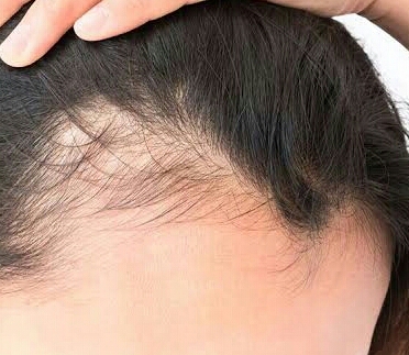 how to stop hair fall men