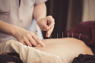 A Quick-Start Guide to Acupuncture