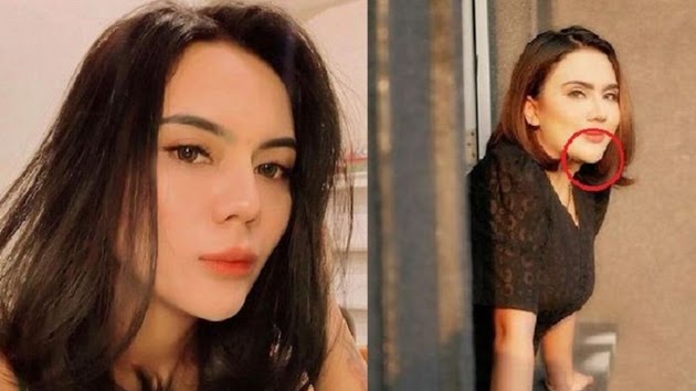 Mau Untung Malah Buntung! Rogoh Kocek Jutaan Demi Tanam Benang, 1 Benda Ganjil Ini Tampak Keluar dari Dahi Artis Cantik ini, 'Korban Sudah Banyak'