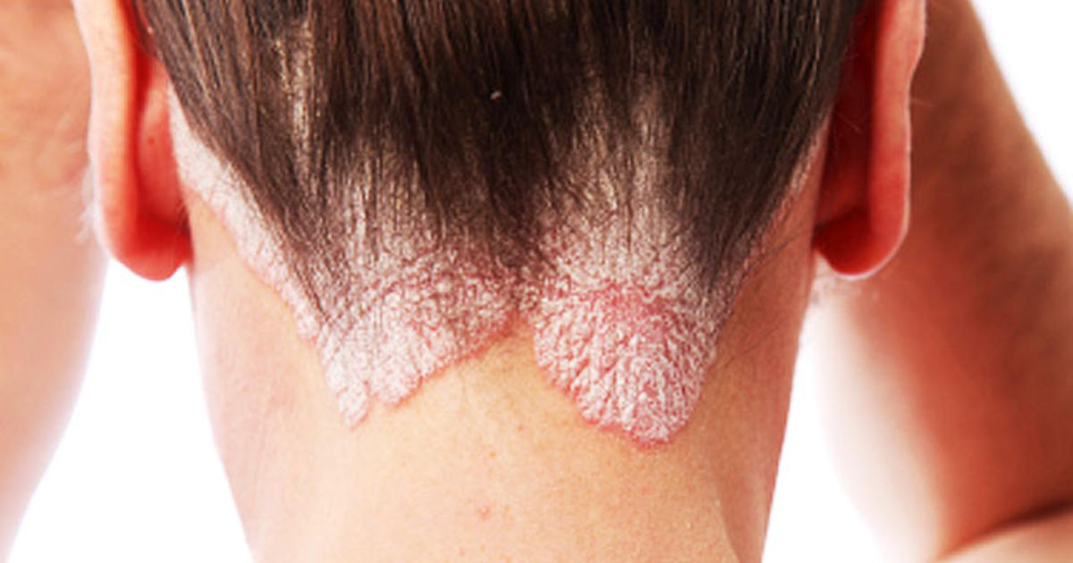 5 Common myths About Psoriasis You Should Know