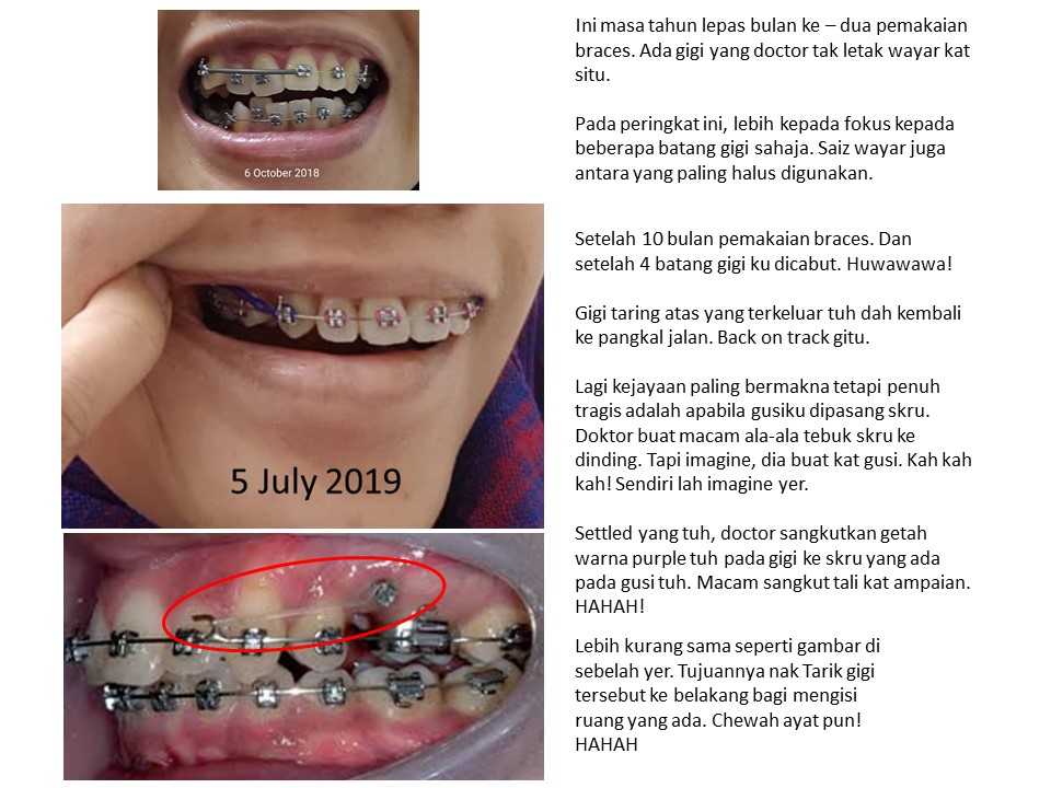 nanyfadhly Braces Story Updated Part 8!