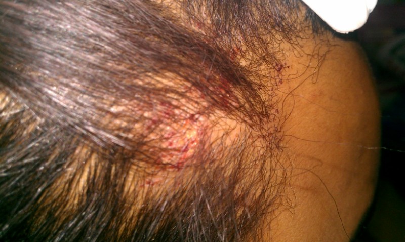 I Have A Scab On My Head That Wont Go Away Is ... - HealthTap