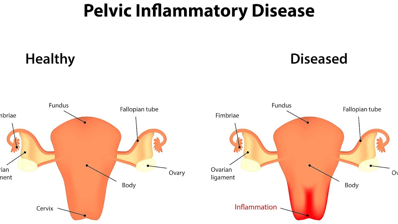 After iud insertion side effects Important Safety