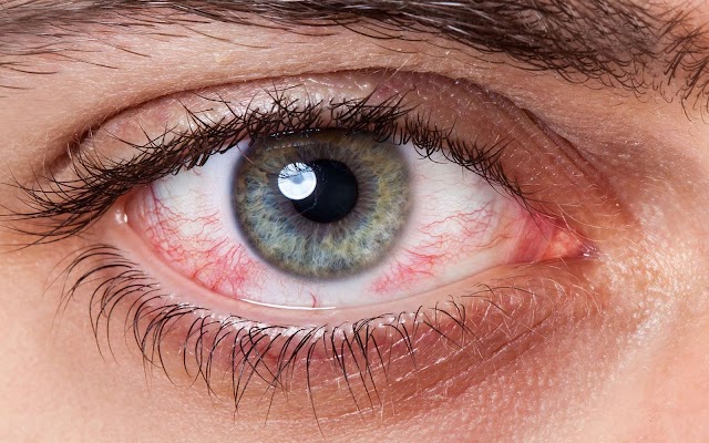 Çağın Hastalığı Göz Tansiyonun 5 Nedeni ve Tedavi Yöntemleri