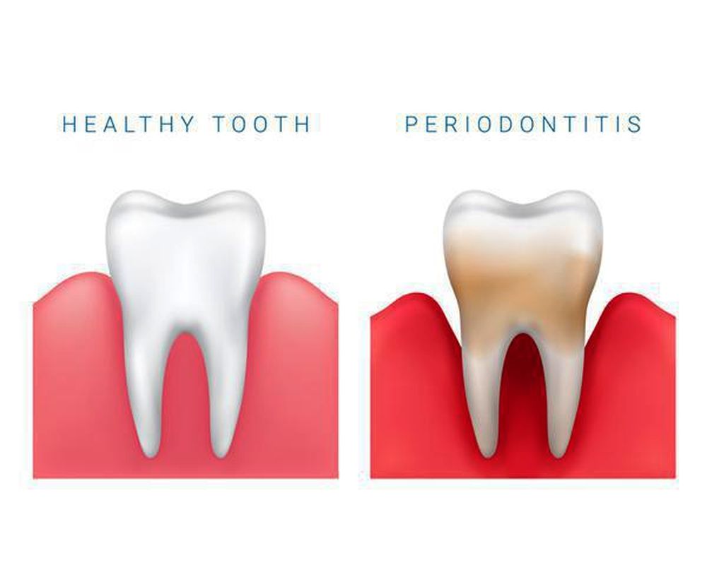 Do You Have Gingivitis or Periodontitis? Different Stages Of Gum