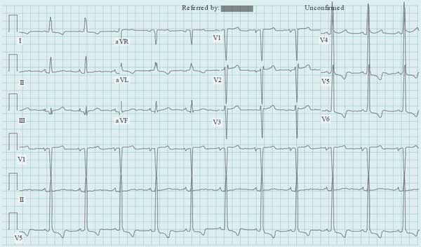 ECG Sudden Cardiac Death