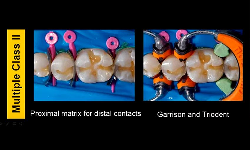 POSTERIOR RESTORATIVE Simplified posterior direct resin composites