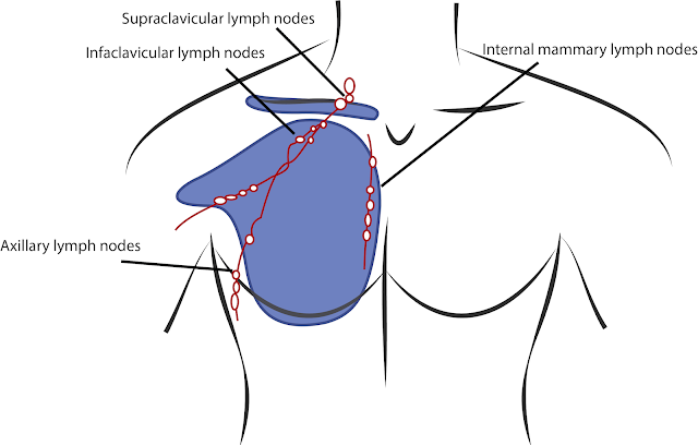 A graphic illustrating male breast cancer
