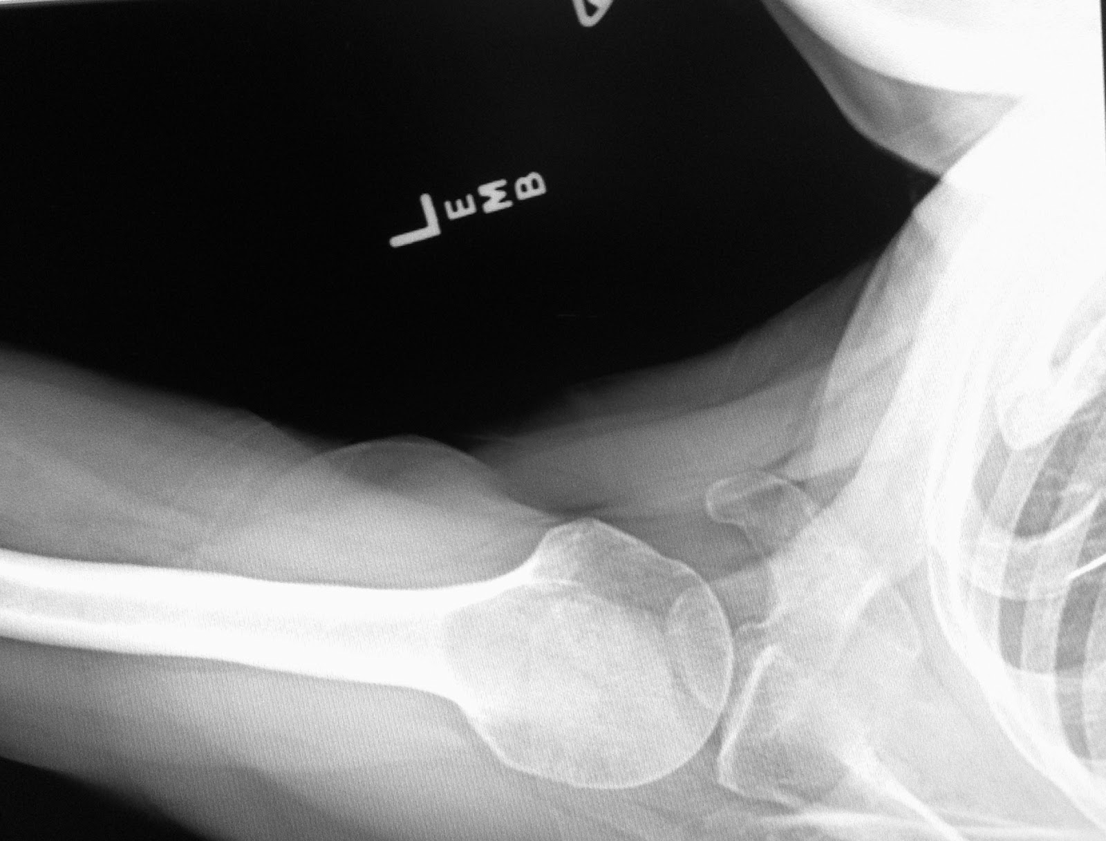 Adhesive Capsulitis Alternative Approach Radiographs for Adhesive Capsulitis