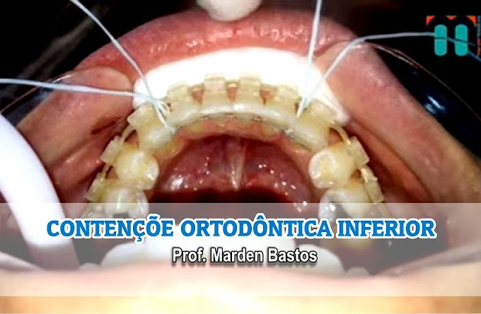 CONTENÇÕES ORTODÔNTICAS: Colagem de Contenção Inferior - Prof. Marden Bastos