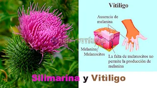 Silimarina-y-Vitiligo