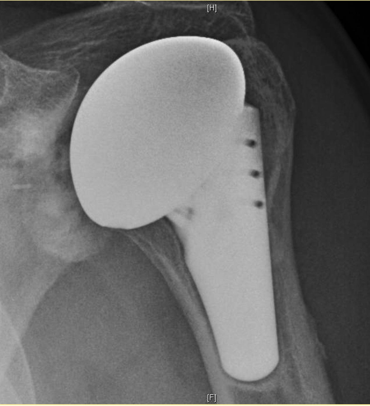 Shoulder Arthritis / Rotator Cuff Tears / Shoulder Pain Total