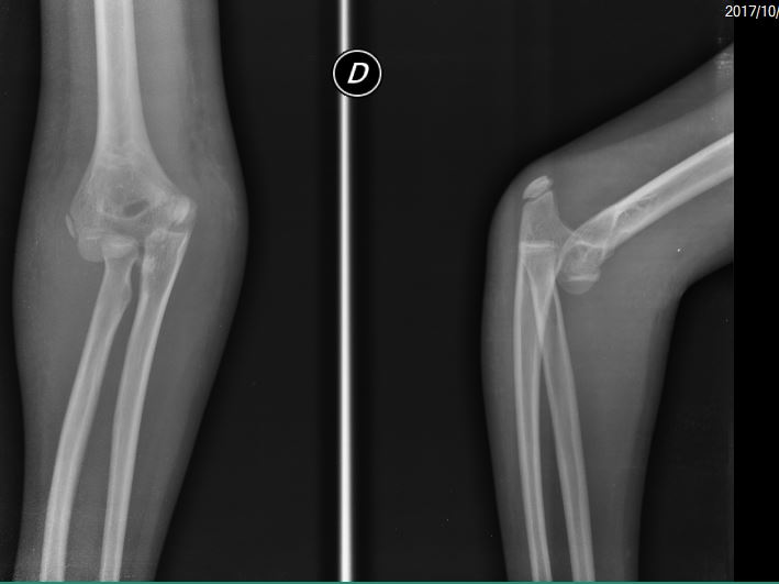 Ortopedia Infantil: 2017