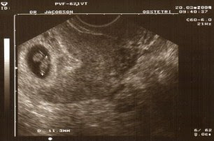 7 haftalık gebelik görüntüsü