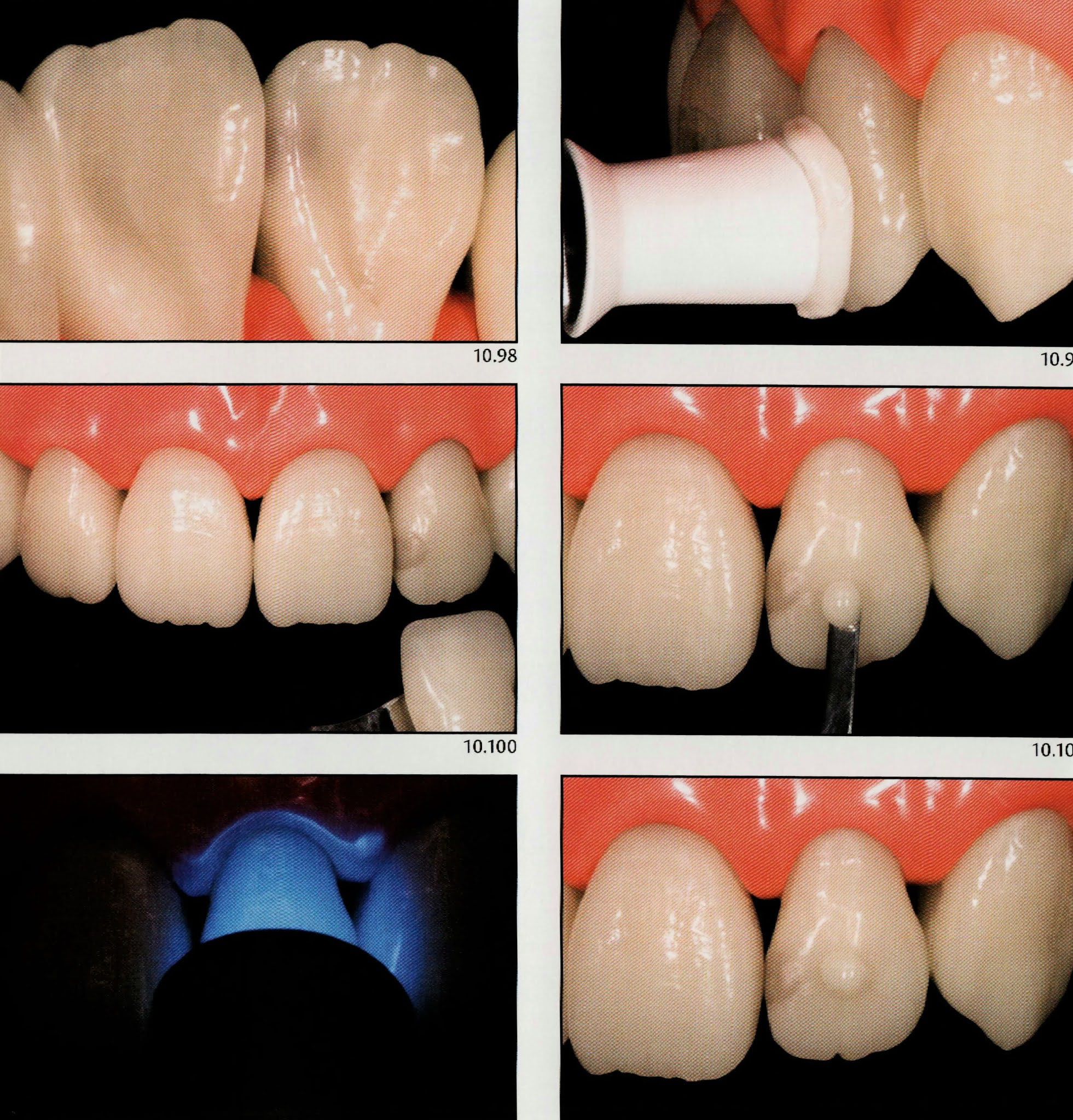 Class III Composite restoration " Labial access " Dental Esthetics