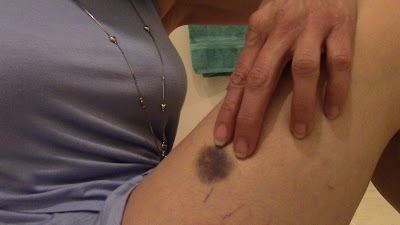 dark purple bruise