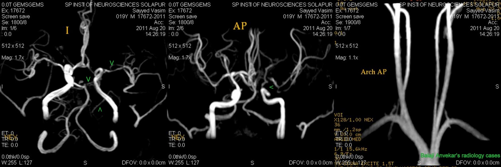 Dr Balaji Anvekar FRCR: Vasculitis induced infarct MRI