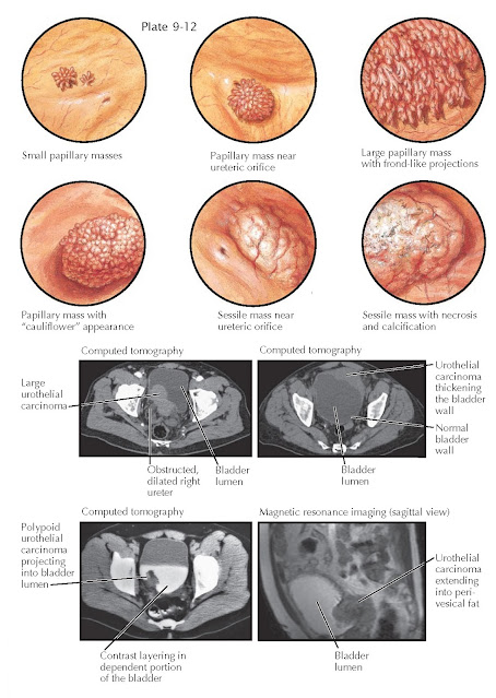 CYSTOSCOPIC AND RADIOGRAPHIC APPEARANCE OF TUMORS OF THE BLADDER