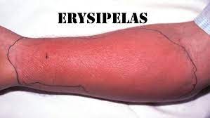 home remedies for erysipelas