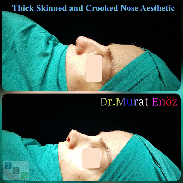 Crooked Nose Aesthetic Surgery For Female Patient Micromoto Assisted Rhinoplasty Istanbul