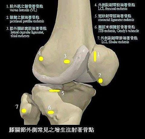 增生療法局部注射 1周後不疼了