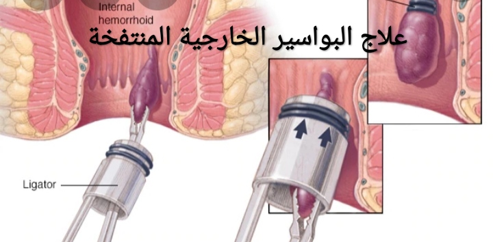 علاج البواسير الخارجية المنتفخة