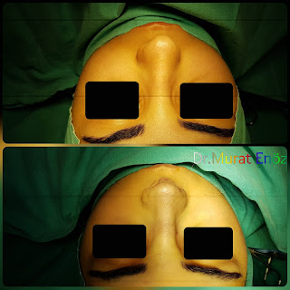 Micromotor Assisted Rhinoplasty, Nose Job Istanbul,Female Nose Aesthetic Turkey,