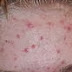 About acne, skin condition And Its Treatment