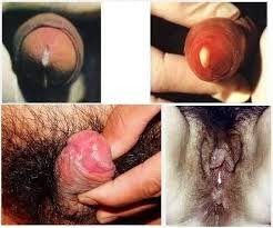 kencing nanah kencing nanah