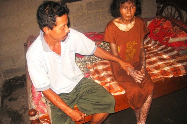 5 Tahun Wanita Ini Berjuang Melawan Kusta