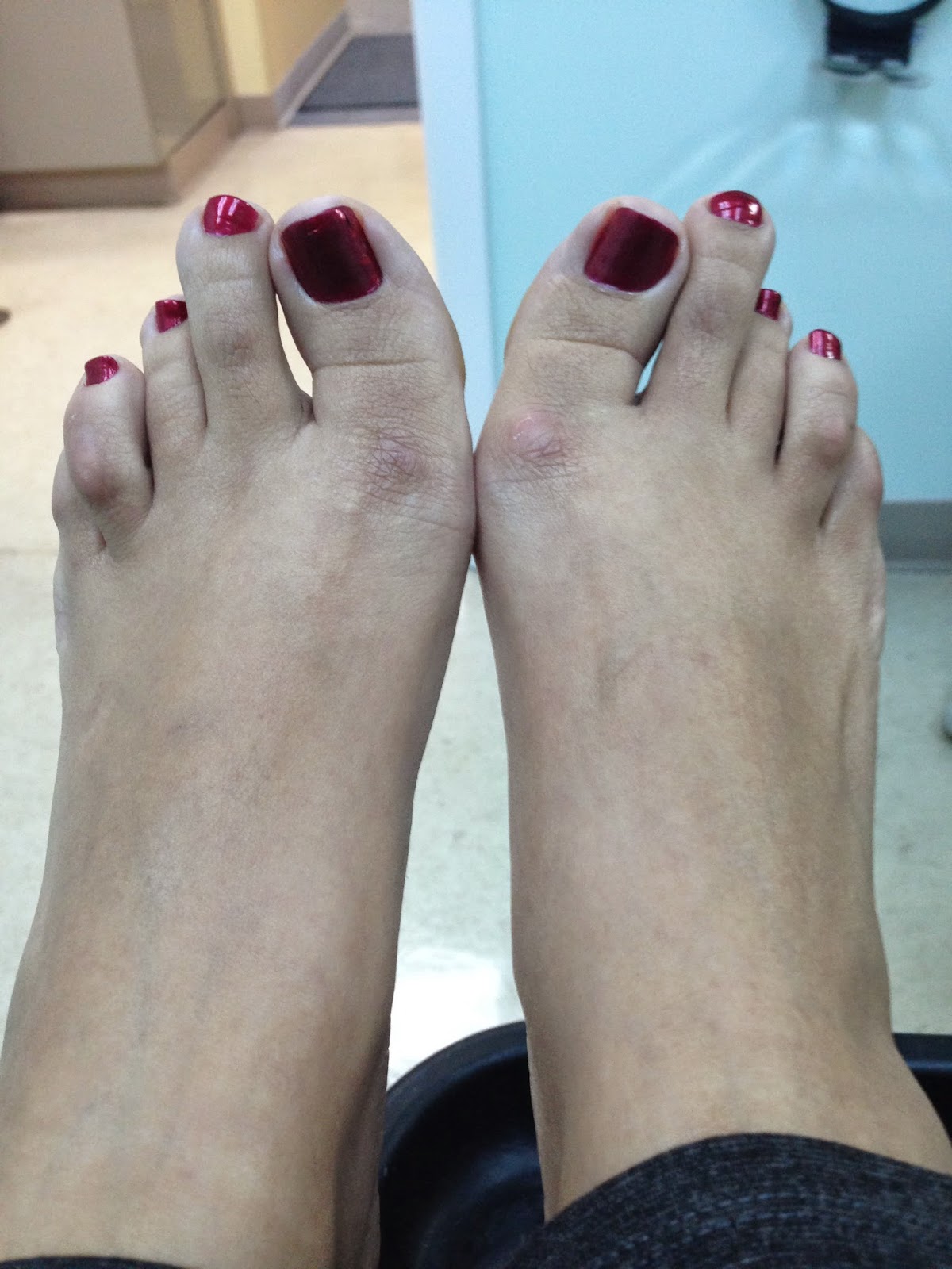 My Toe Shortening Surgery Experience First Toe, Left Foot!