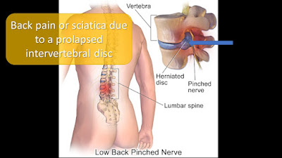 Experience with Lumbar Disc Surgery (L4-5 microdiscectomy)