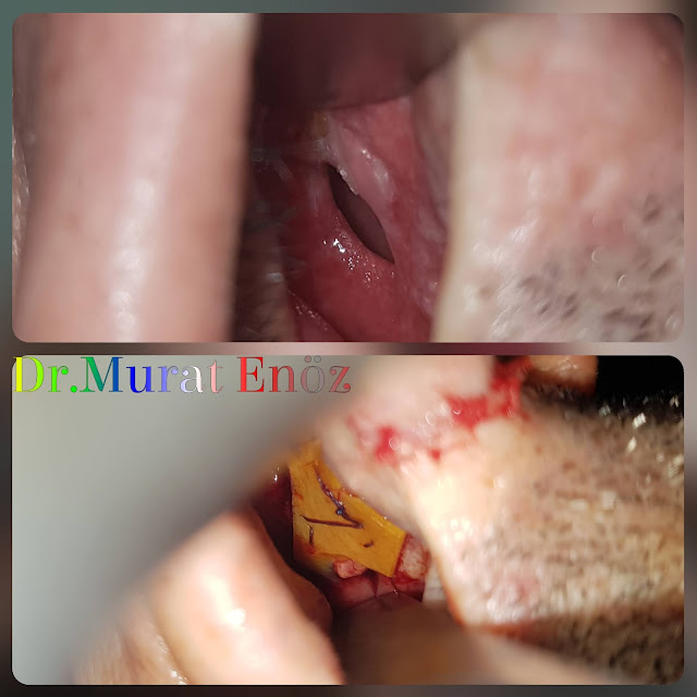 Nasal Septum Perforation Closure - Treatment in Turkey Istanbul