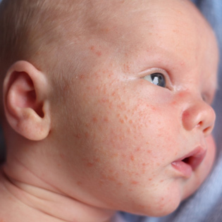 Baby Acne Cure and Treatment: Baby Acne Pictures
