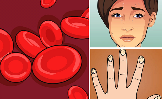 Get Anemia Sintomas Ng Leukemia Sa Babae PNG